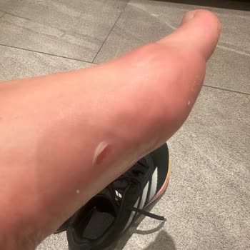 Adidas Ayakkabımın Rahatsızlığına Çözüm Bekliyorum