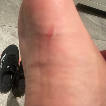 Adidas Ayakkabımın Rahatsızlığına Çözüm Bekliyorum