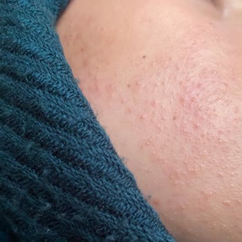 Nemlendirici Krem Felaketi: Cildim Mahvoldu!