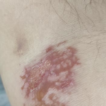 Hatalı Müdahale Sonucu Kalıcı İz Ve Güven Kaybı