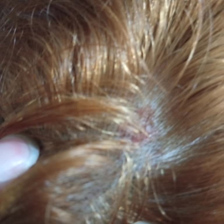 Saç Açıcı Ürünün Ciltte Yarattığı Sorun