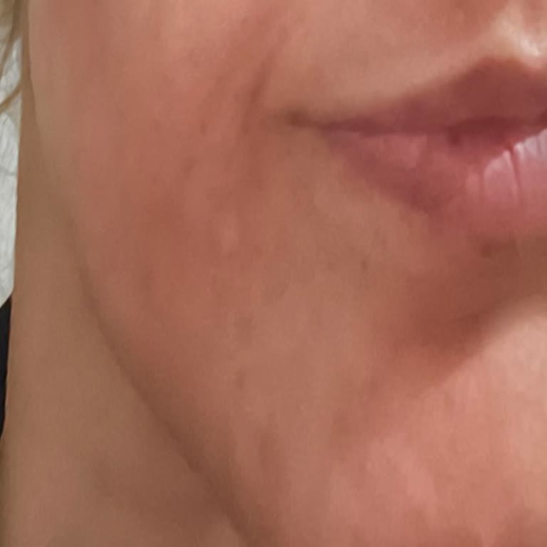 Yves Rocher Pure Menthe Ürünü Cildimi Tahriş Etti