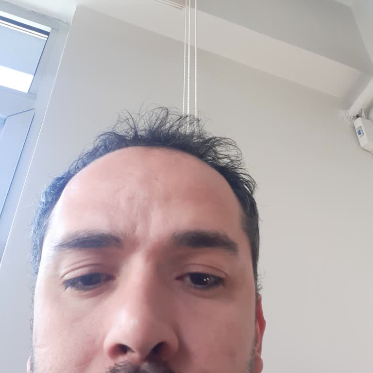 Başarısız Burun Ameliyatı Sonrası Hayal Kırıklığı