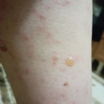 Lazer Epilasyon Sonrası Cilt Yanıkları Ve İlgisizlik