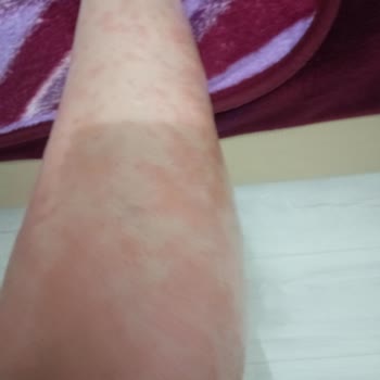 Lazer Epilasyon Sonrası Cilt Yanıkları Ve İlgisizlik