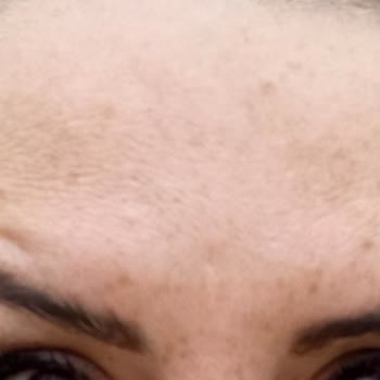 Botox Sonrası Hayal Kırıklığı Ve İletişim Sorunları