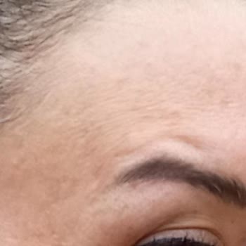 Botox Sonrası Hayal Kırıklığı Ve İletişim Sorunları