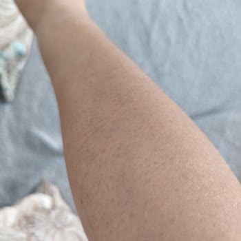 Deluxe Vip Güzellik Merkezi Epilasyon Hizmetinde Hayal Kırıklığı Ve Hormon Testi Sorunu