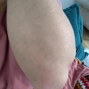 Deluxe Vip Güzellik Merkezi Epilasyon Hizmetinde Hayal Kırıklığı Ve Hormon Testi Sorunu