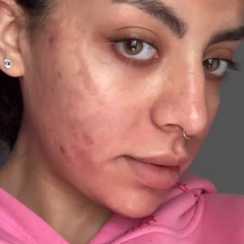 Güzellik Merkezinde Yaşadığımız Cilt Hasarı Ve Ödeme Sorunları