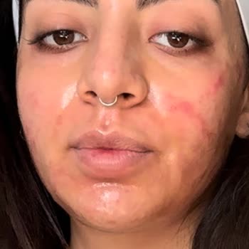 Güzellik Merkezinde Yaşadığımız Cilt Hasarı Ve Ödeme Sorunları