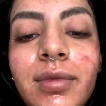 Güzellik Merkezinde Yaşadığımız Cilt Hasarı Ve Ödeme Sorunları