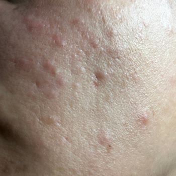 Pirinç Özlü Sabun Yüzümde Sivilce Ve Kabarcık Yaptı