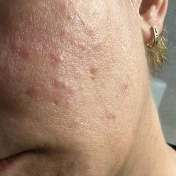 Pirinç Özlü Sabun Yüzümde Sivilce Ve Kabarcık Yaptı