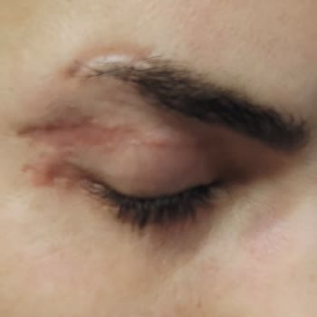 Ameliyat Sonrası Göz Kapağımda Kalıcı İzler Ve Görme Sorunu Yaşadım