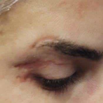 Ameliyat Sonrası Göz Kapağımda Kalıcı İzler Ve Görme Sorunu Yaşadım