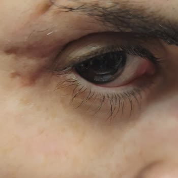 Ameliyat Sonrası Göz Kapağımda Kalıcı İzler Ve Görme Sorunu Yaşadım