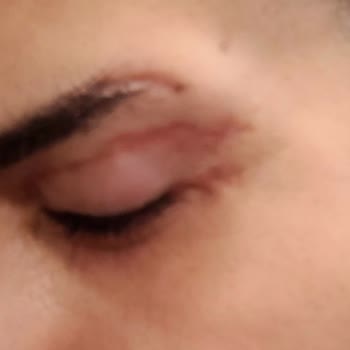 Ameliyat Sonrası Göz Kapağımda Kalıcı İzler Ve Görme Sorunu Yaşadım