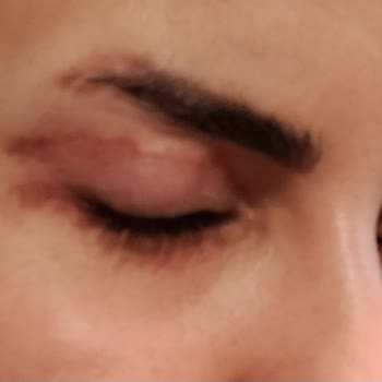 Ameliyat Sonrası Göz Kapağımda Kalıcı İzler Ve Görme Sorunu Yaşadım