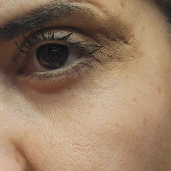 Ameliyat Sonrası Göz Kapağımda Kalıcı İzler Ve Görme Sorunu Yaşadım