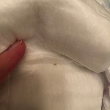 Bebek Bezi İçinde Yabancı Cisim Şoku