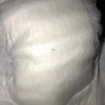 Bebek Bezi İçinde Yabancı Cisim Şoku