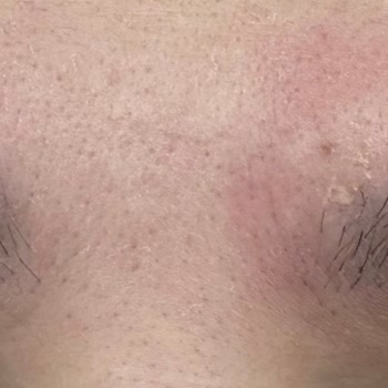 Saç Açıcı Kullanımı Sonrası Cilt Yanığı Ve Tahriş