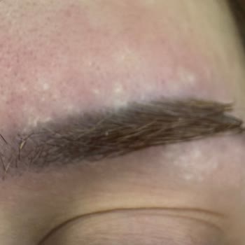 Saç Açıcı Kullanımı Sonrası Cilt Yanığı Ve Tahriş