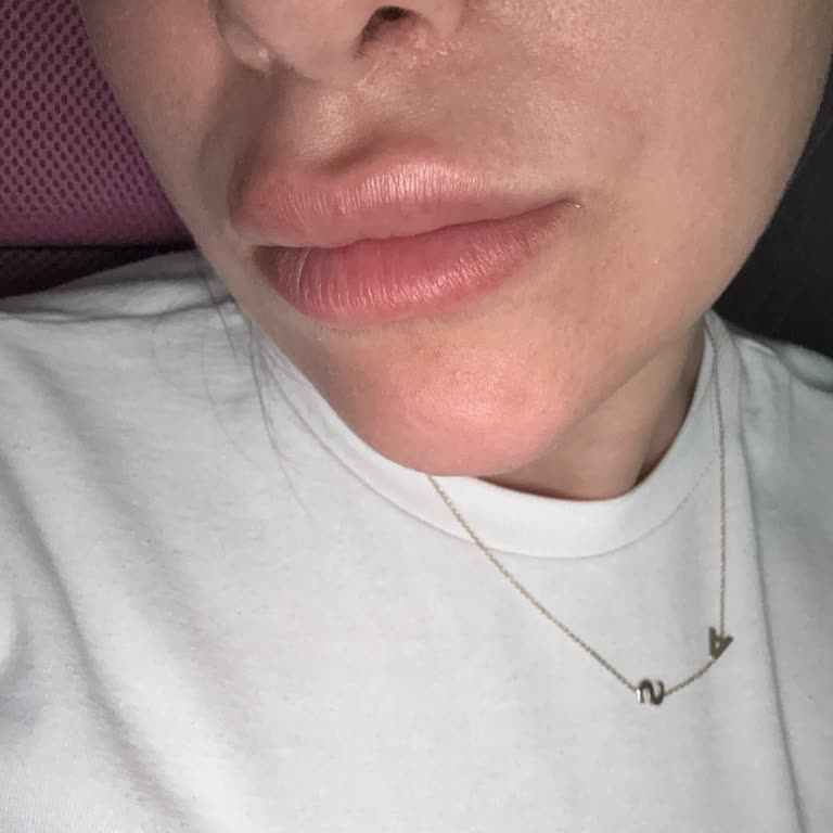 Cilt Ürünleri Yüzümde Soyulma Ve Kabarıklık Yaptı