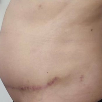 Ameliyat Sonrası Sorunlar Ve İletişim Eksikliği Mağduriyet Yarattı