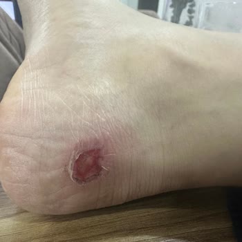 Aldığım Ayakkabılar Ayağımı Parçaladı, Para İadesi İstiyorum