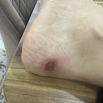 Aldığım Ayakkabılar Ayağımı Parçaladı, Para İadesi İstiyorum