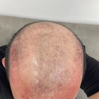 BB Saç Protez Merkezinde Hayal Kırıklığı Ve Sağlık Sorunu