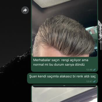 BB Saç Protez Merkezinde Hayal Kırıklığı Ve Sağlık Sorunu