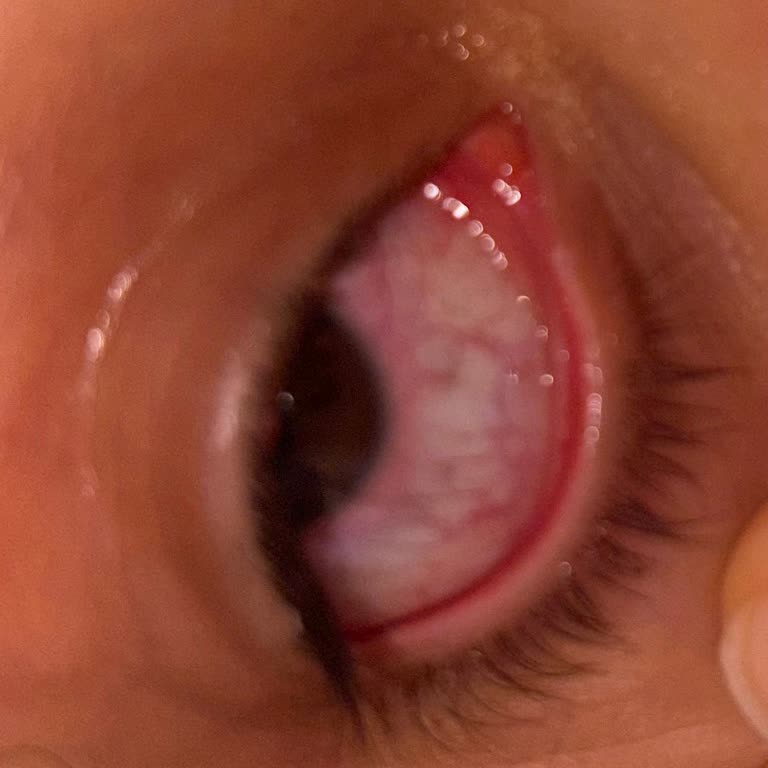 Bidünya Lens Şikayeti