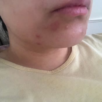 Kullandığım Fondöten Sonrası Yüzümde İrinli Sivilceler Oluştu