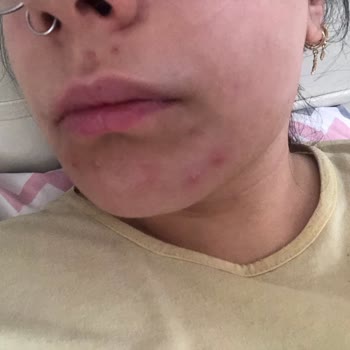 Kullandığım Fondöten Sonrası Yüzümde İrinli Sivilceler Oluştu