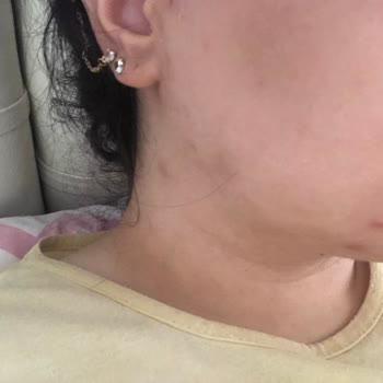 Kullandığım Fondöten Sonrası Yüzümde İrinli Sivilceler Oluştu