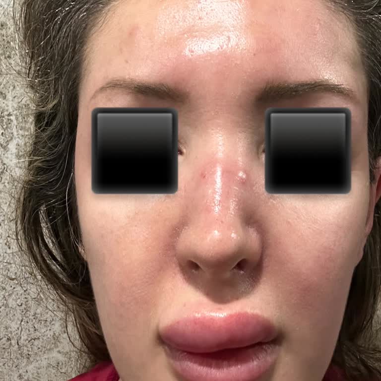 Vitomix İşlemi Sonrası Ciddi Sağlık Sorunları Yaşadım