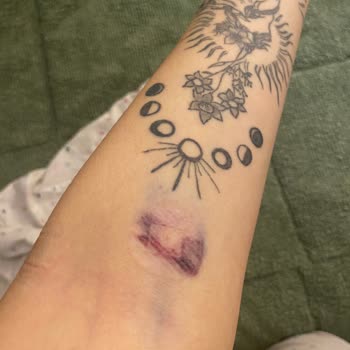 Acil Serviste Yanlış Serum Uygulaması Sonucu Kolum Morardı Ve Bilgilendirilmedim