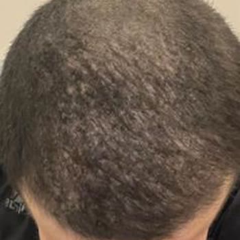 Saç İşlemi Sonuçsuz Kaldı, Mağduriyetim Giderilmedi