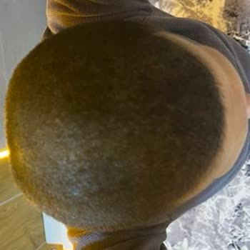 Saç İşlemi Sonuçsuz Kaldı, Mağduriyetim Giderilmedi