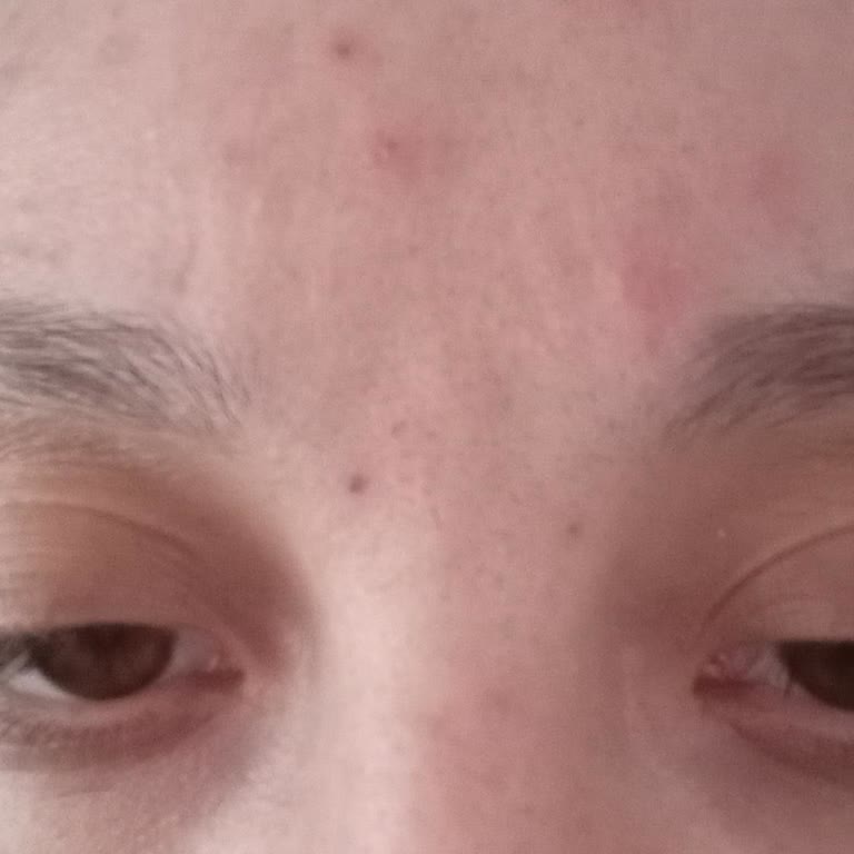 Blendax Şampuan Sonrası Cildimde Yanma Ve Saçlarımda Kepek Sorunu Yaşadım