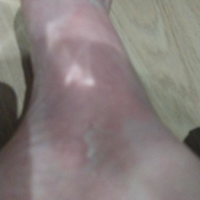 Gratis'ten Aldığım Ayak Maskesi Yanık Ve Acı Verdi