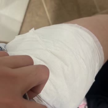 Otobüs Yolculuğunda Dökülen Kahve Nedeniyle Yanık Ve Yetersiz İlk Yardım