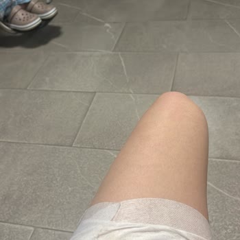 Otobüs Yolculuğunda Dökülen Kahve Nedeniyle Yanık Ve Yetersiz İlk Yardım