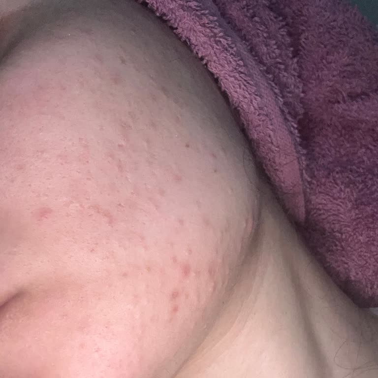 Yanlış Ürün Tavsiyesiyle Cildim Mahvoldu Telafi Bekliyorum