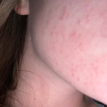Nemlendirici Kullanımı Sonrası Cilt Sorunları Deneyimi