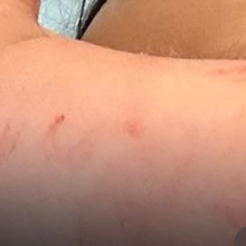 Çocuk Kan Alma Servisinde Acemice Uygulama Mağduriyeti