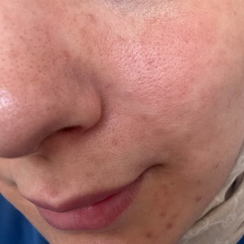 Aldığım Yüz Temizleme Ürünleri Cildimde Kızarıklık Yaptı